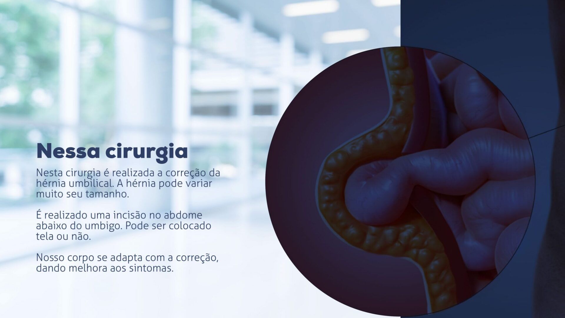 D Vidas Sobre Hernioplastia Umbilical Cirurgia De Corre O De H Rnia