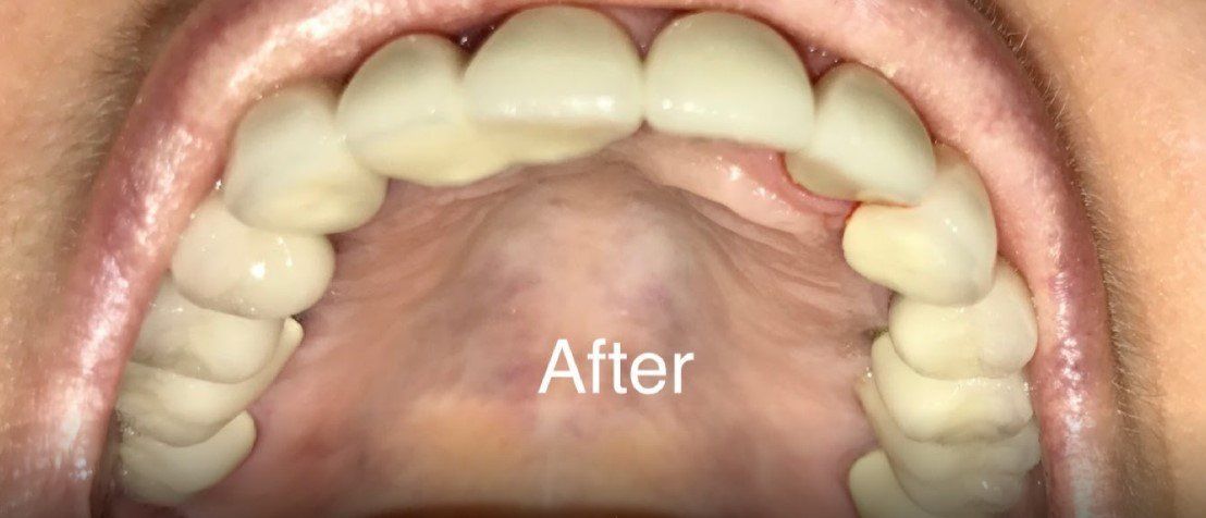 Implant Overdentures In Manchester Windsor Ct Signature Smiles