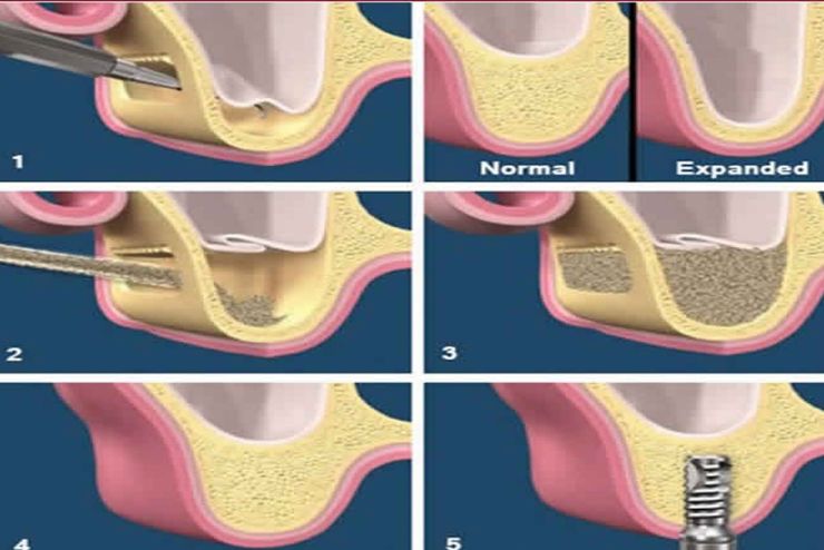 Bone Graft For Dental Implants Montreal Bone Graft Specialist