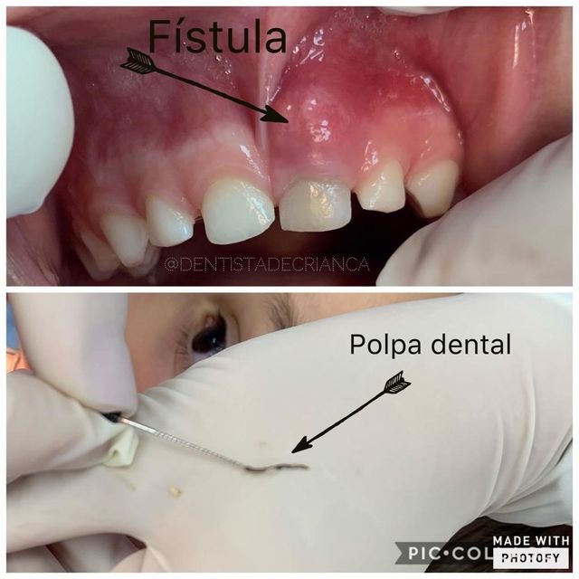 Introduzir 101 Imagem Dente Nascendo No Fundo Da Boca Br