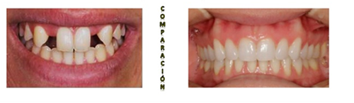 AnodontiaCongenital Absence Of Teeth