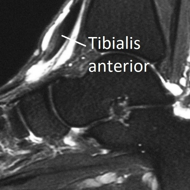 Tibialis Anterior Tendinopathy Dr Ben Beamond Adelaide