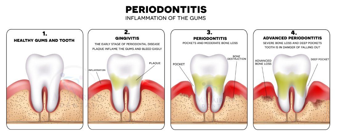 Healthy Gums Vs Unhealthy Gums Oral And Overall Health