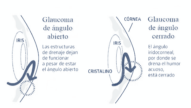 Los Tipos M S Comunes De Glaucoma