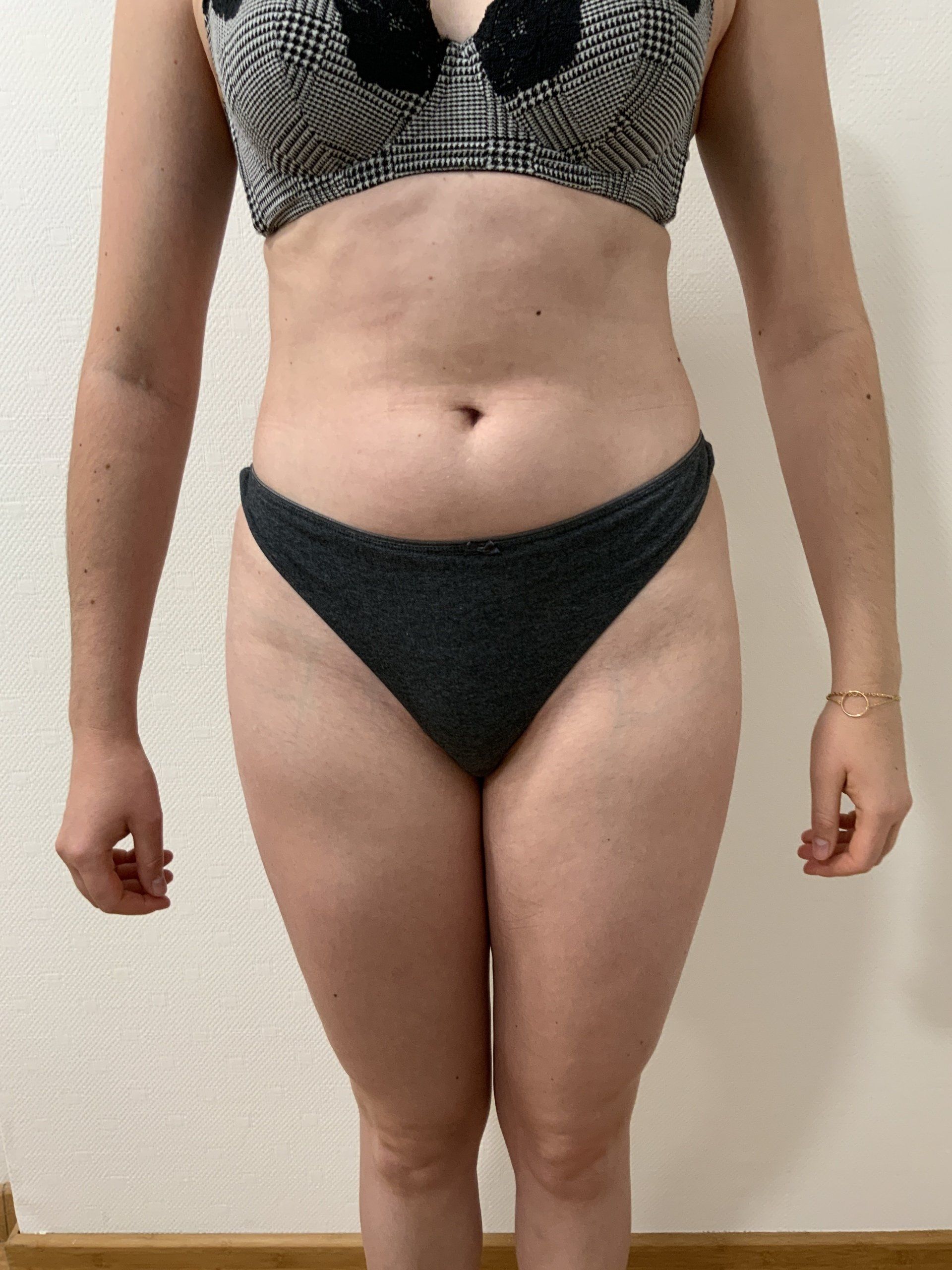 Liposuccion Du Ventre Et Lipoaspiration Abdominale Dr Delobaux