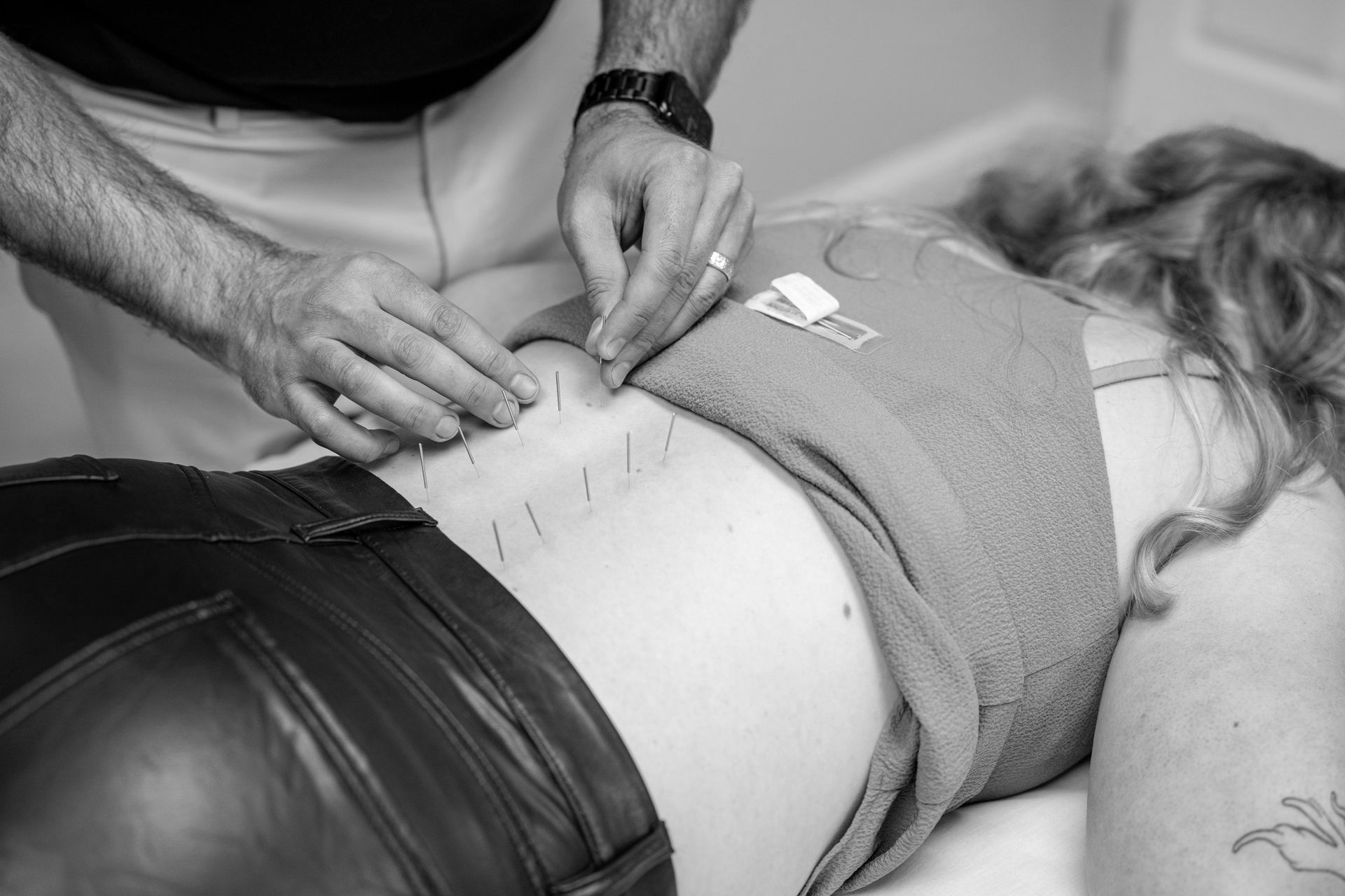 A black and white photo of a woman getting acupuncture on her back.