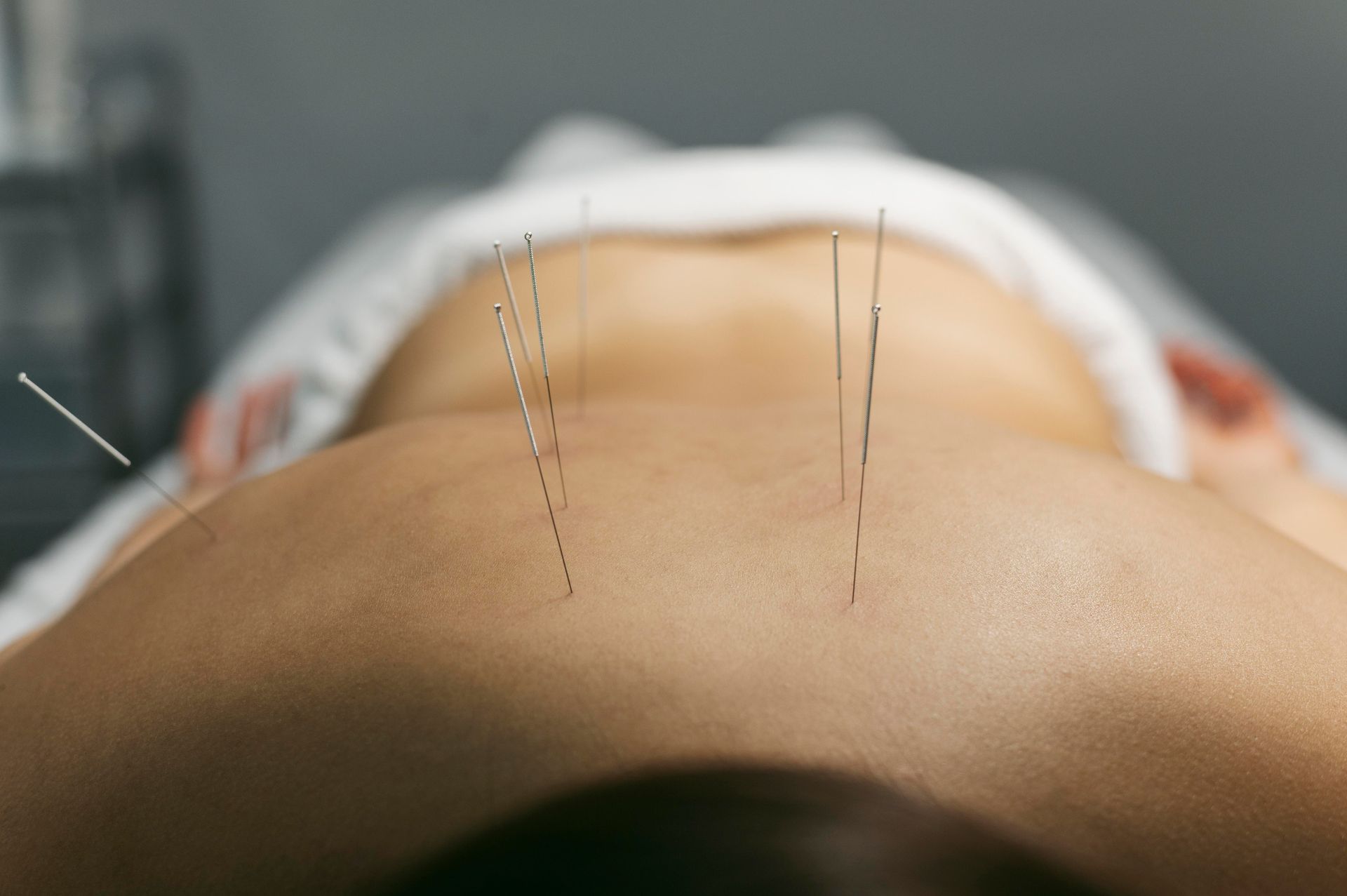 patient getting acupuncture