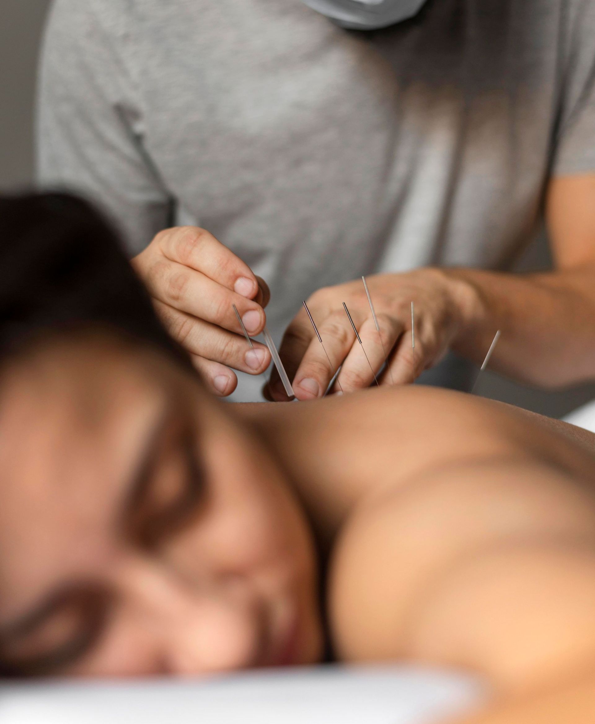 man getting acupuncture