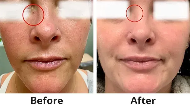 A before and after photo of a woman 's face.