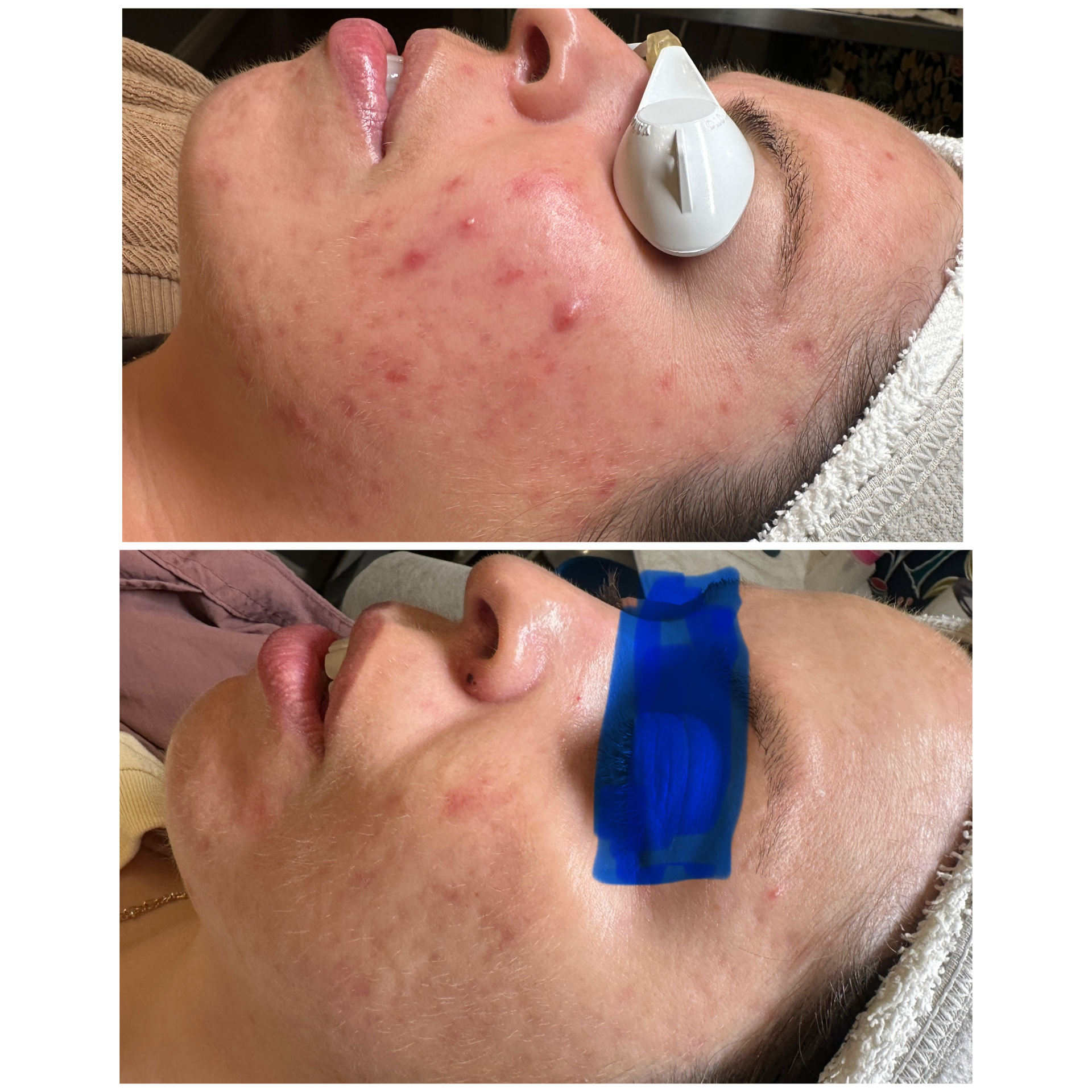 Before and after photos of person's face with acne: top with device, bottom with ice pack.