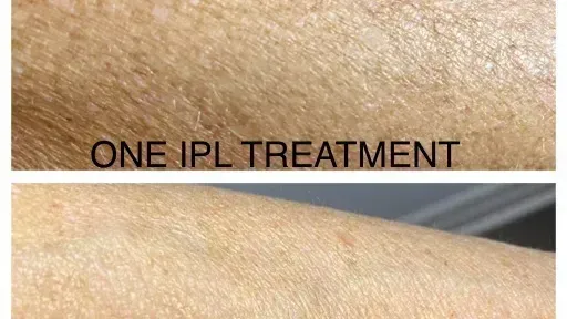 A before and after photo of a person 's arm with ipl treatment.
