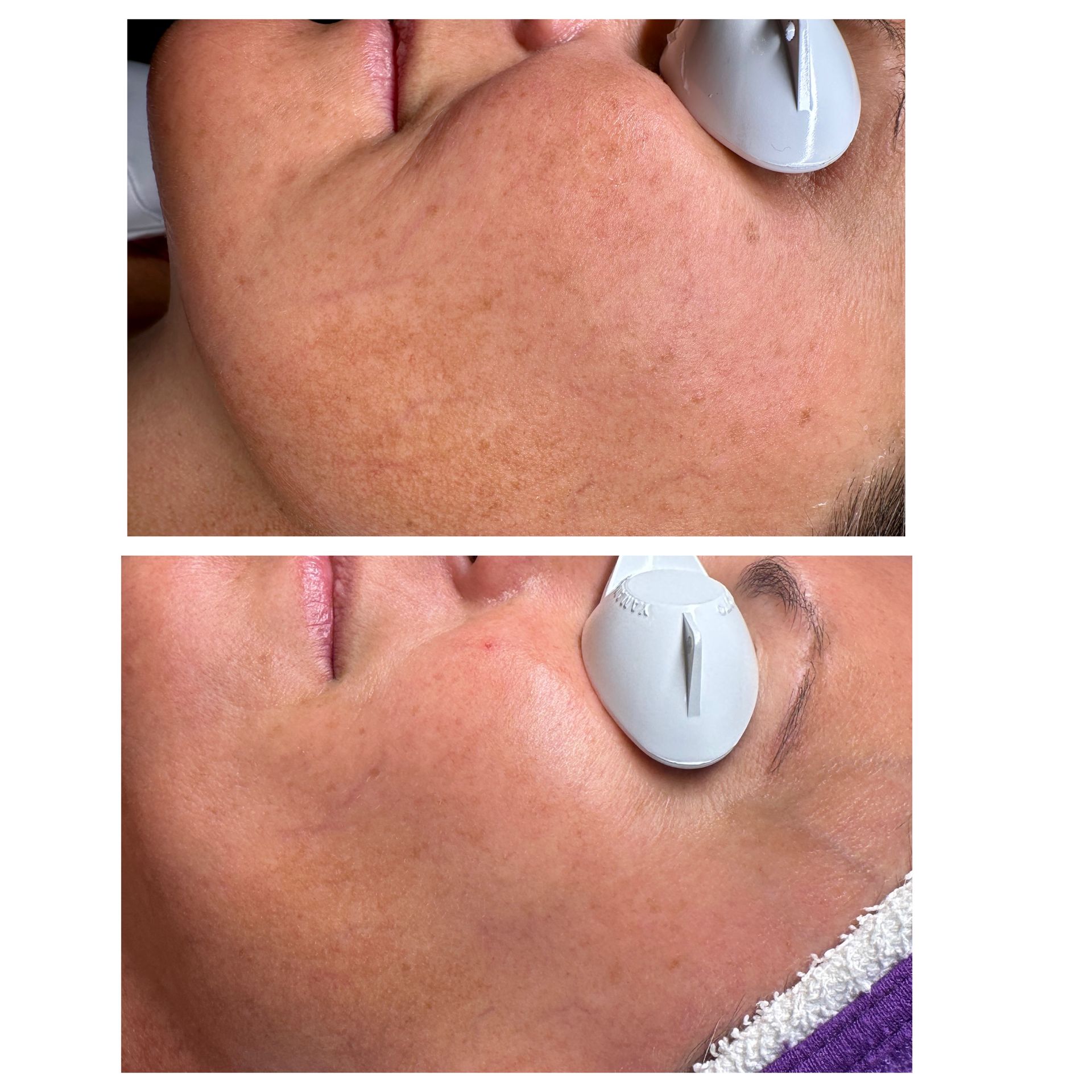 A before and after picture of a woman 's face with a device on it.