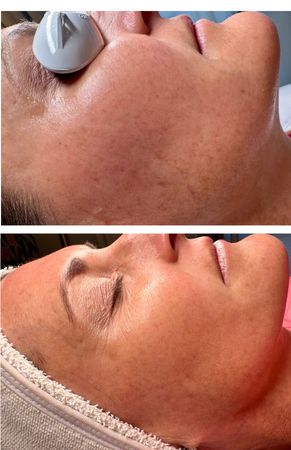 Before and After 2 BioRePeel Treatments