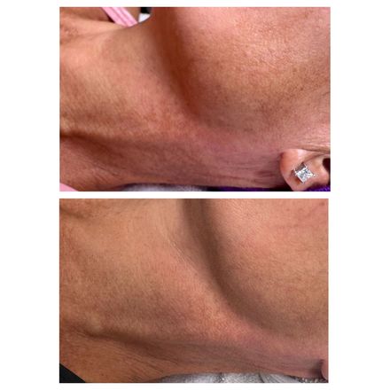 Before and After two BioRePeel Treatments.