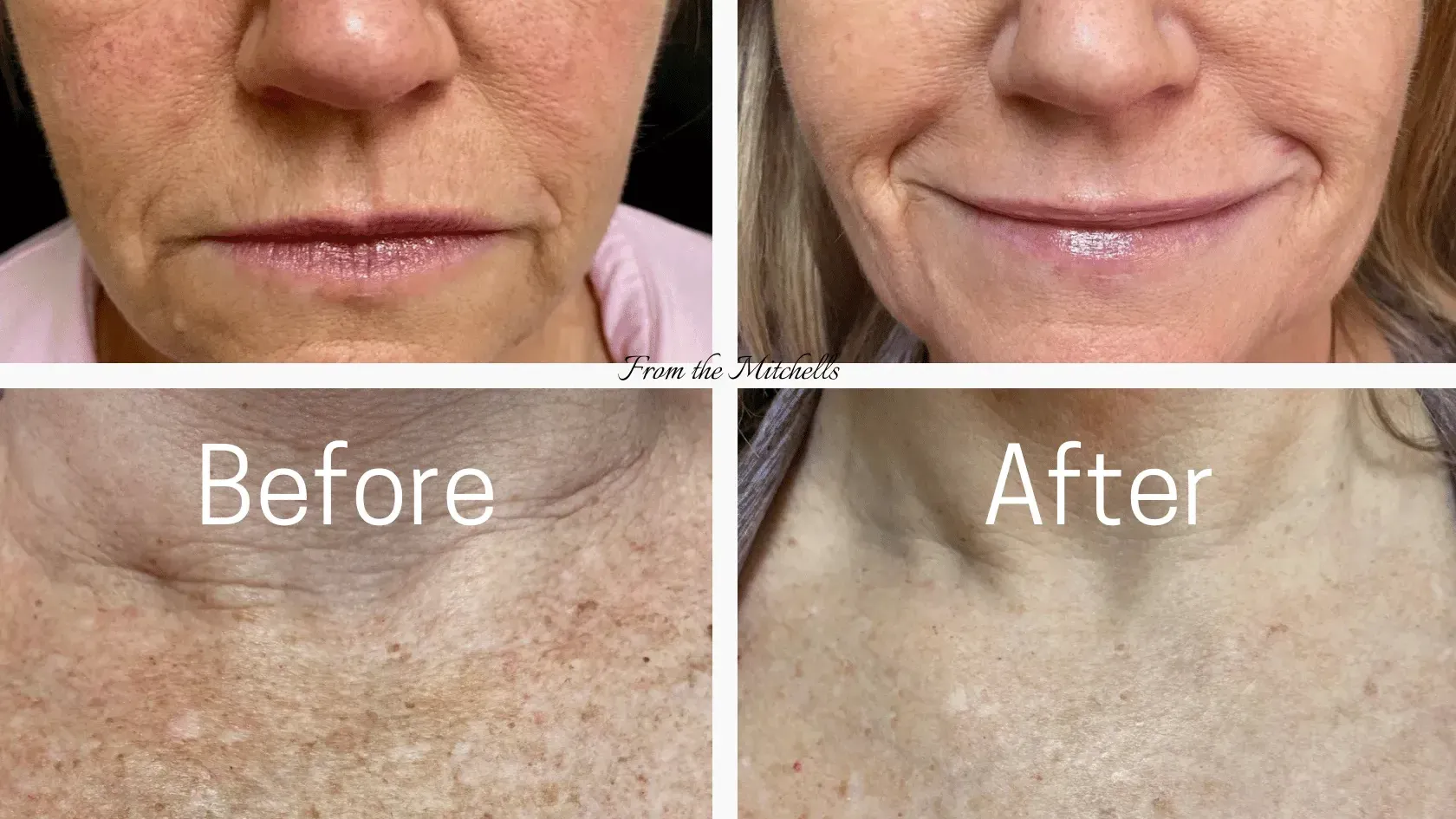 A before and after photo of a woman 's face and neck.