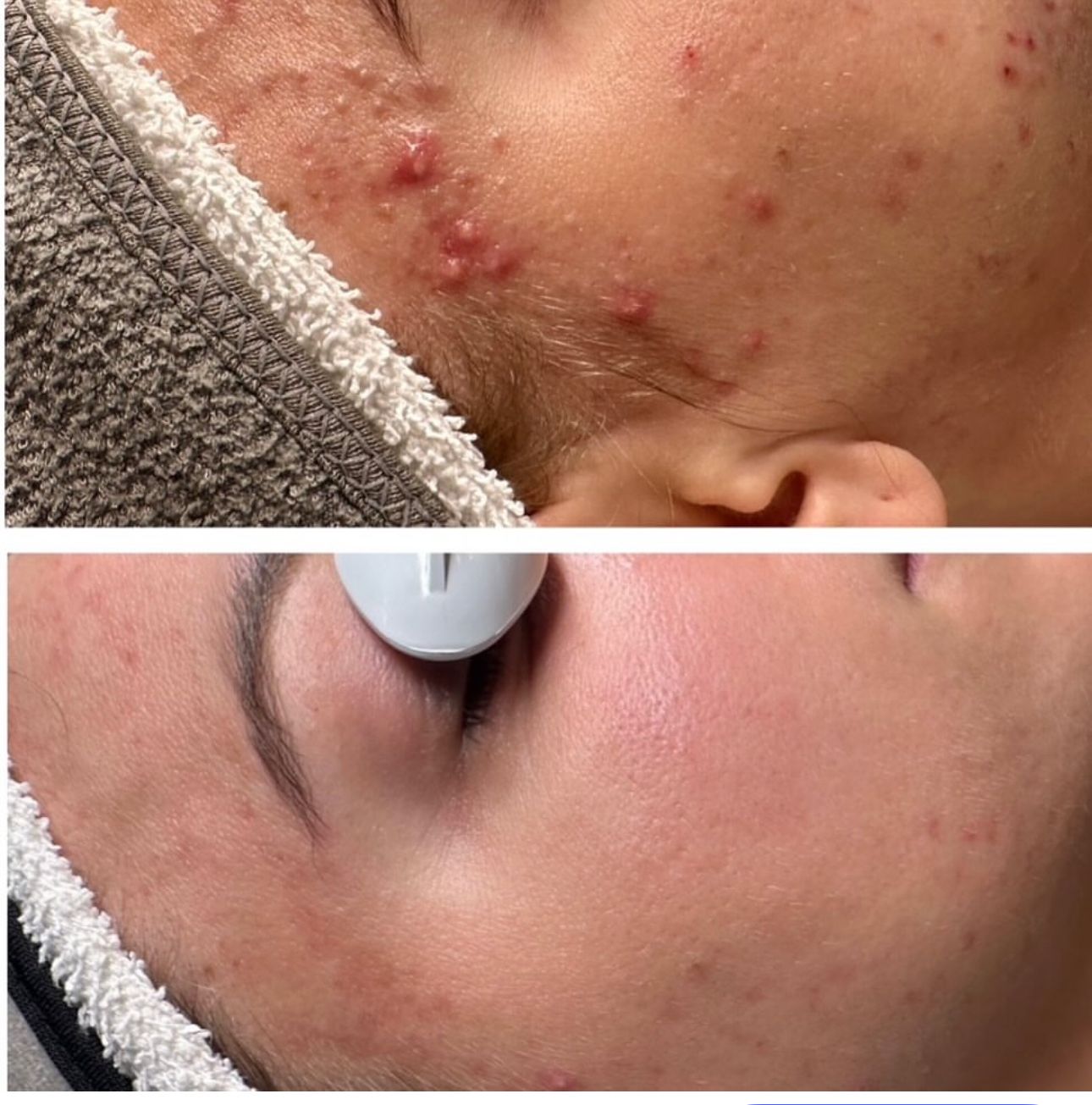 Top: Face with acne. Bottom: Face with reduced redness, smoother skin.