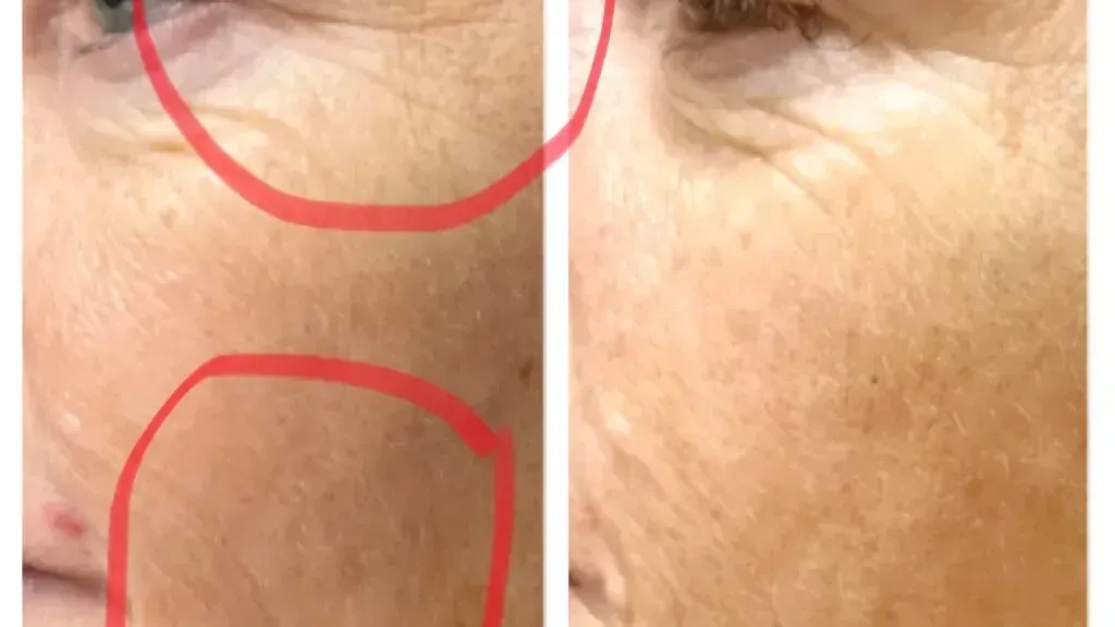 A before and after photo of a woman 's face with red circles.