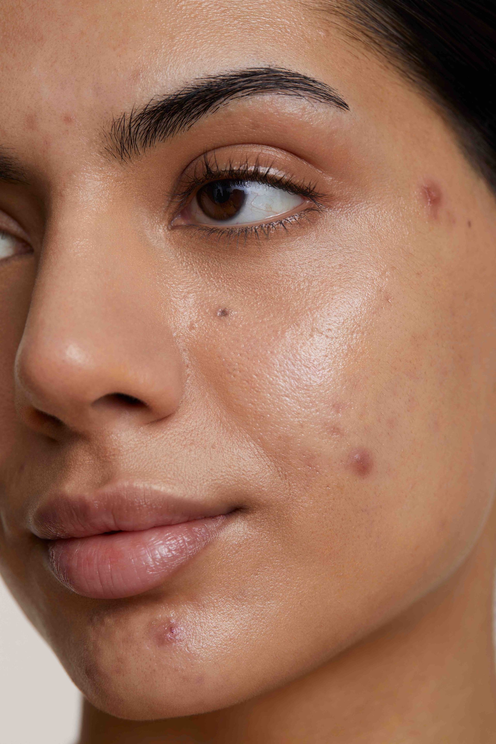 Woman with acne blemishes