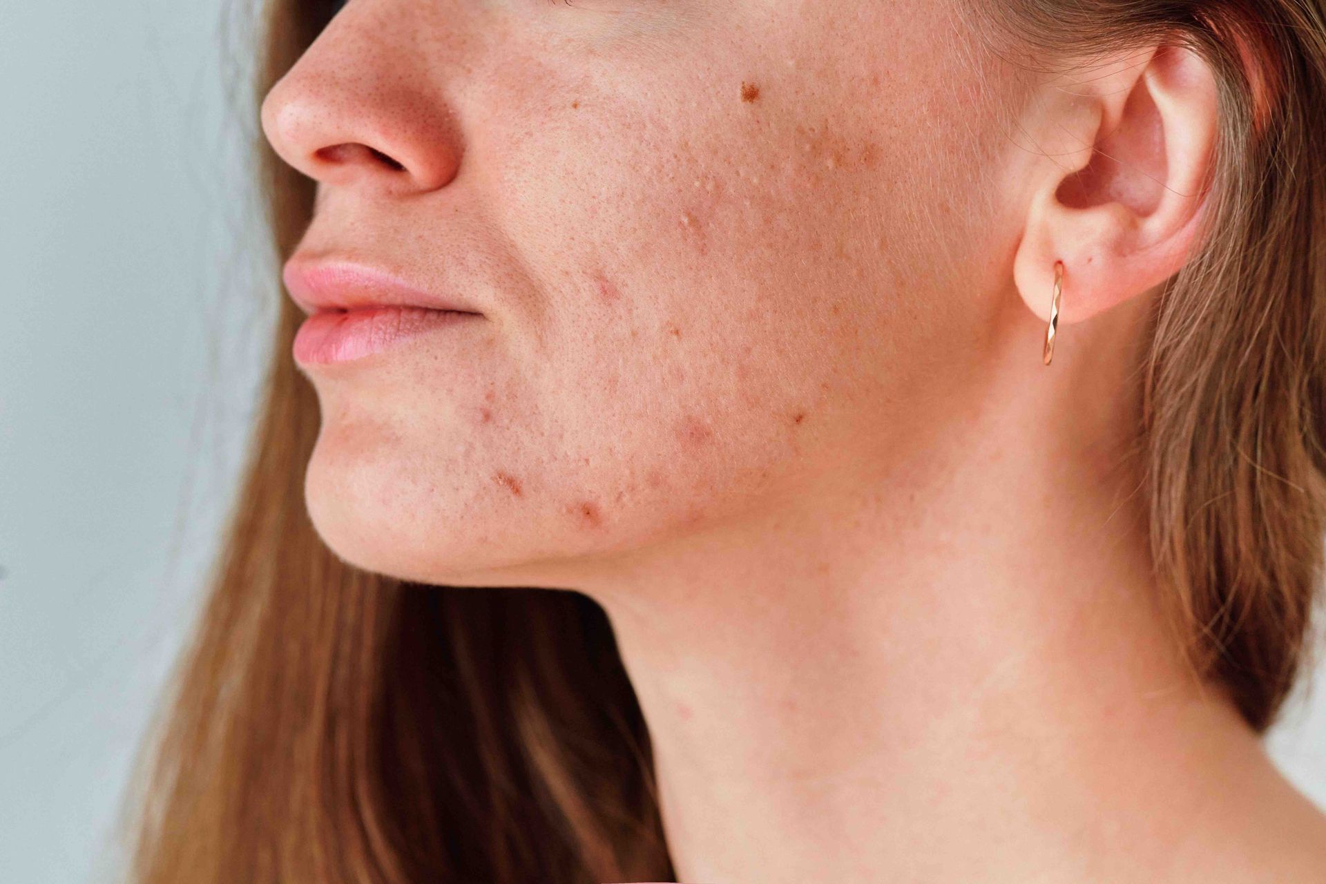 A close up of a woman 's face with acne and earrings.