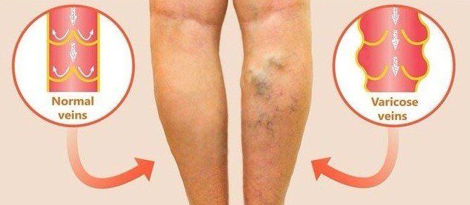 after sclerotherapy treatment
