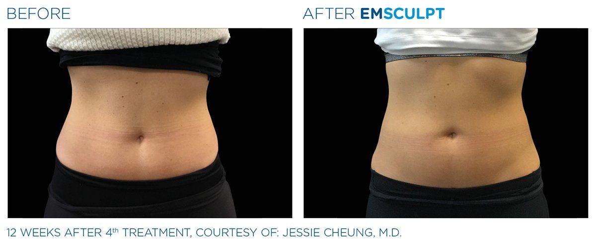 Columbus Emsculpt — 12 Weeks Treatment Results in Columbus, OH
