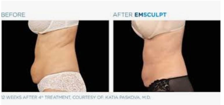 columbus_emsculpt_before_and_after