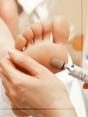 Callus peel treatment
