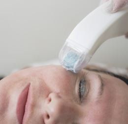 Callus peel treatment