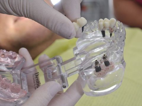 Имплантация  - стоматологическая клиника Perladents в Юрмале