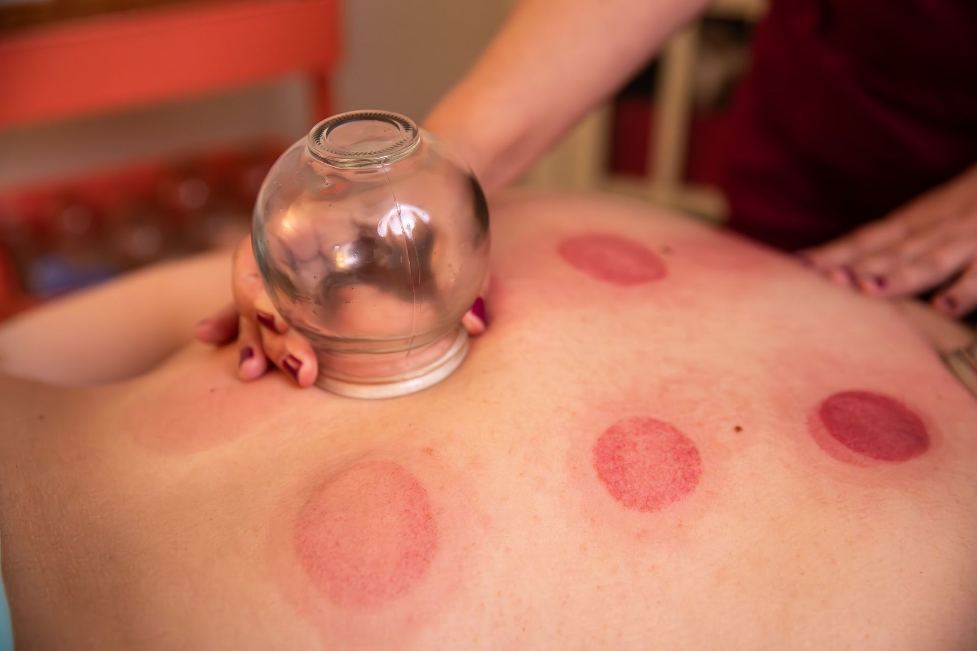 Person receiving cupping therapy on their back, red circular marks present.