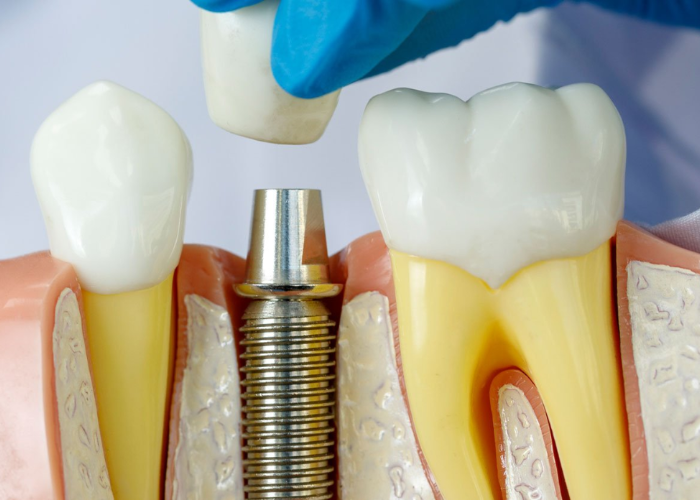 Model of a tooth with a dental implant, showing component parts being assembled.