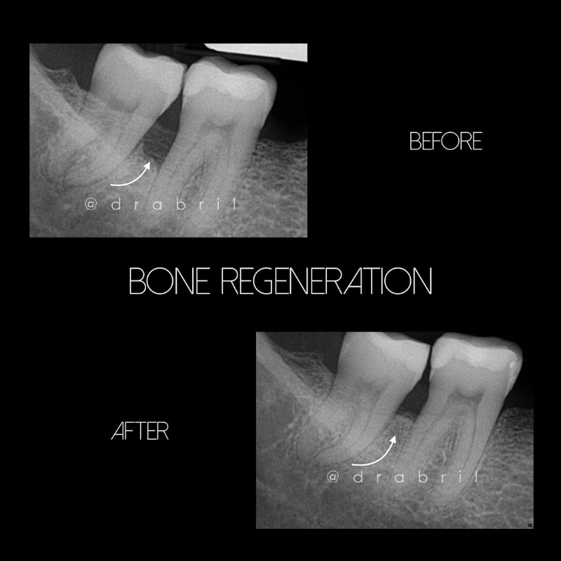Before-and-after dental X-rays showing bone regeneration between two lower molars.