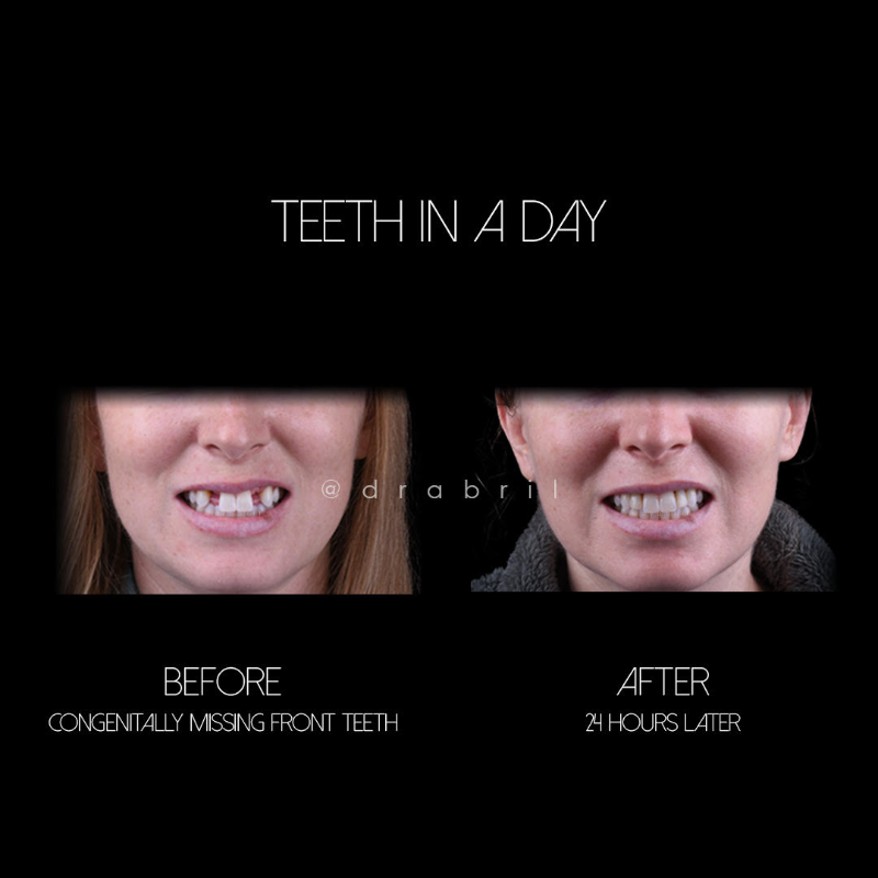 Before and after comparison of dental restoration for missing front teeth, labeled 