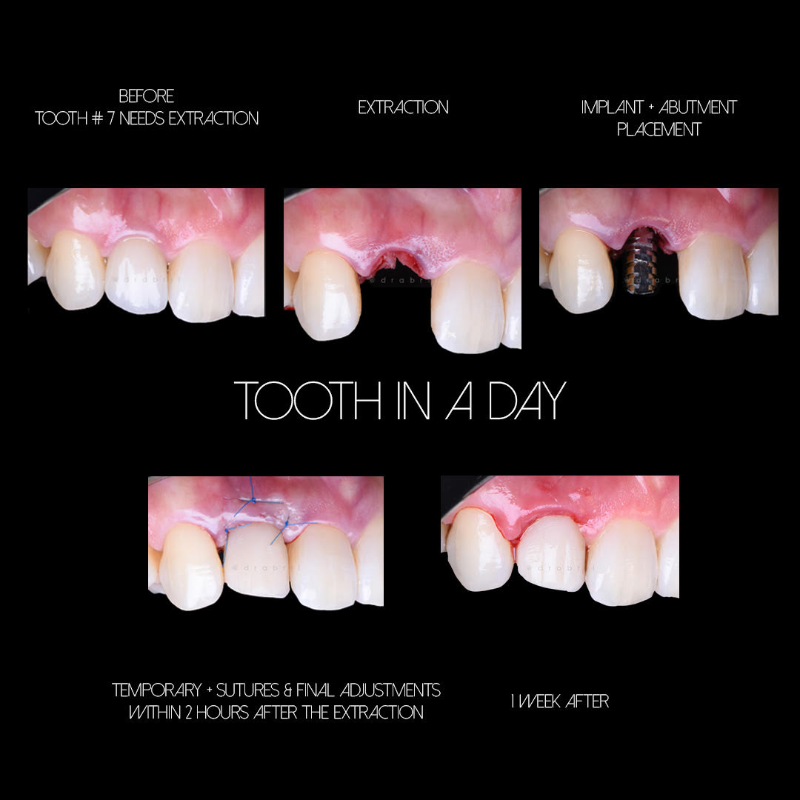 A sequence of photos showing a tooth extraction, dental implant placement, and temporary crown restoration in one day.