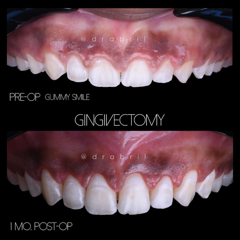 Before and after comparison of a gingivectomy procedure to treat a gummy smile, showing increased tooth exposure.