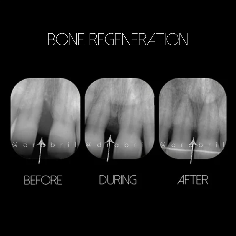 Three dental X-rays showing progressive bone regeneration between two teeth over time.