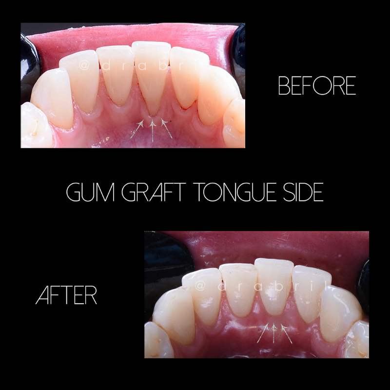 Before and after comparison of a gum graft procedure on the tongue side of the lower front teeth.
