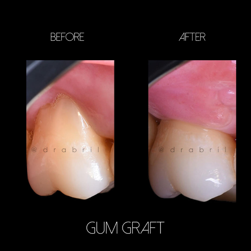 Before and after images of a gum graft procedure on a tooth, showing improved gum coverage.