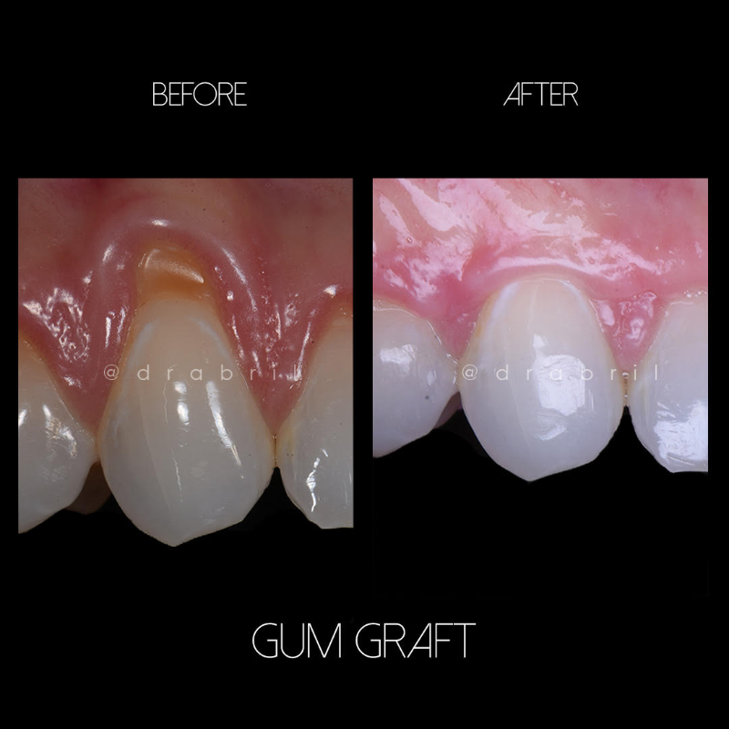 Before and after comparison of a gum graft procedure, showing restored gum coverage on a tooth.