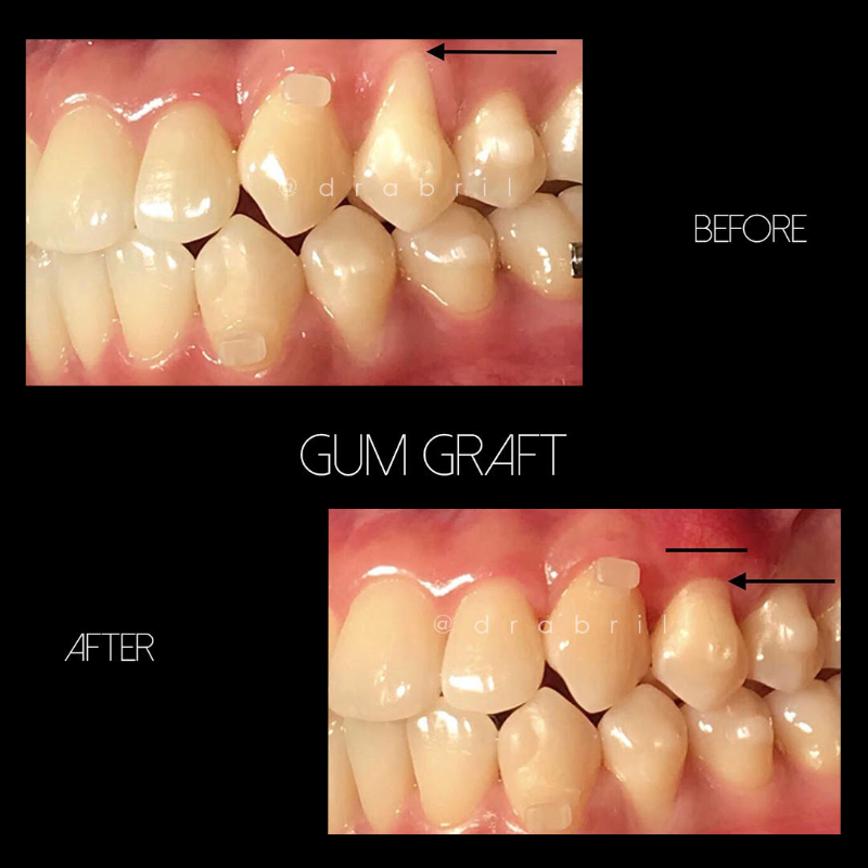 Before and after photos of a gum graft procedure, showing improved gum coverage on an upper tooth.