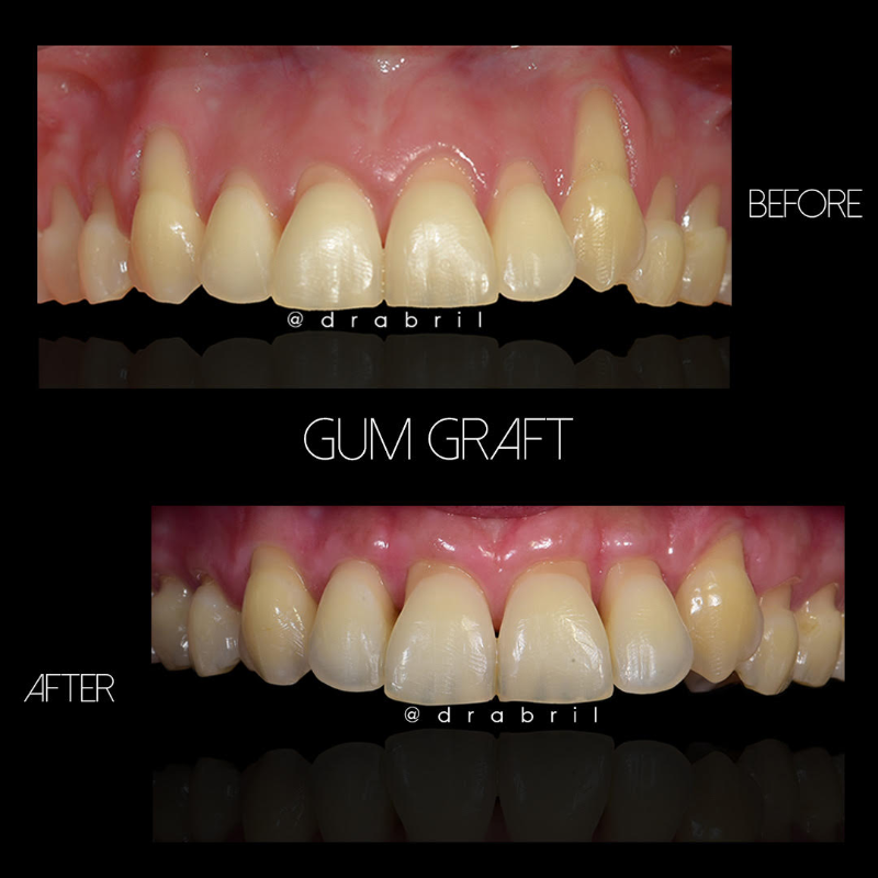 Before-and-after comparison showing gum graft treatment to restore gum tissue covering exposed tooth roots.
