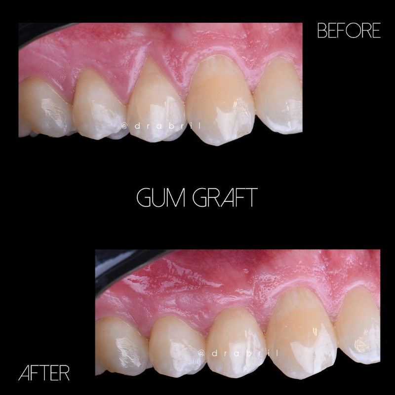 Before-and-after photos of teeth showing successful gum tissue restoration after a gum graft procedure.