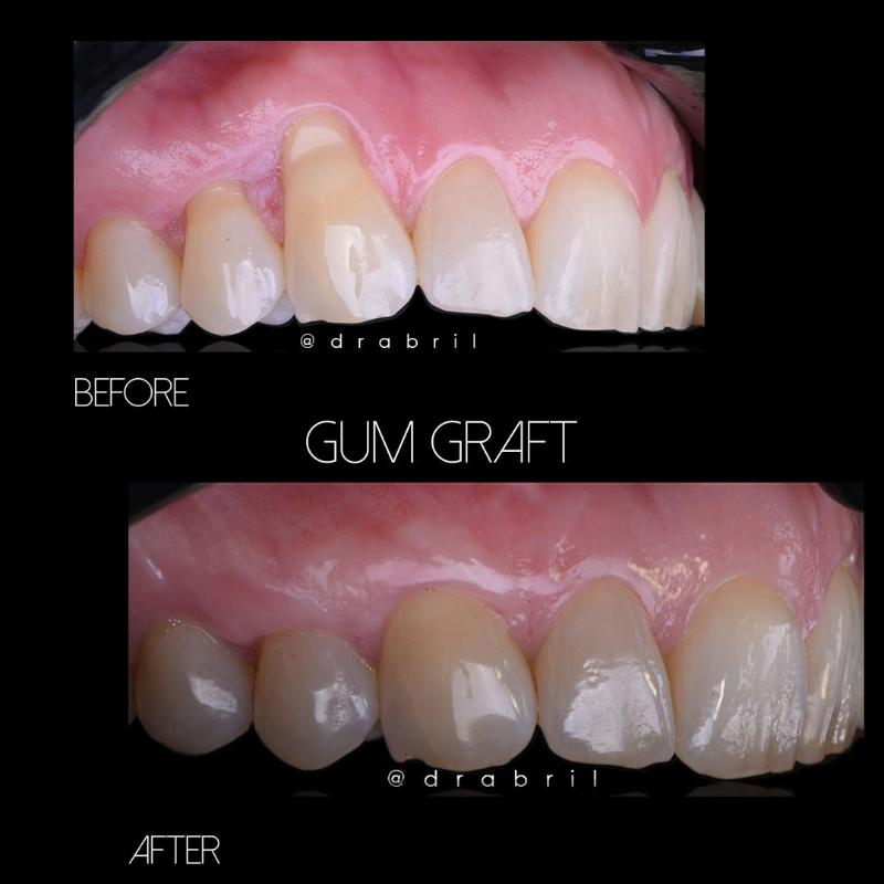 Before and after comparison of a patient’s gum line showing successful tissue regeneration from a gum graft procedure.