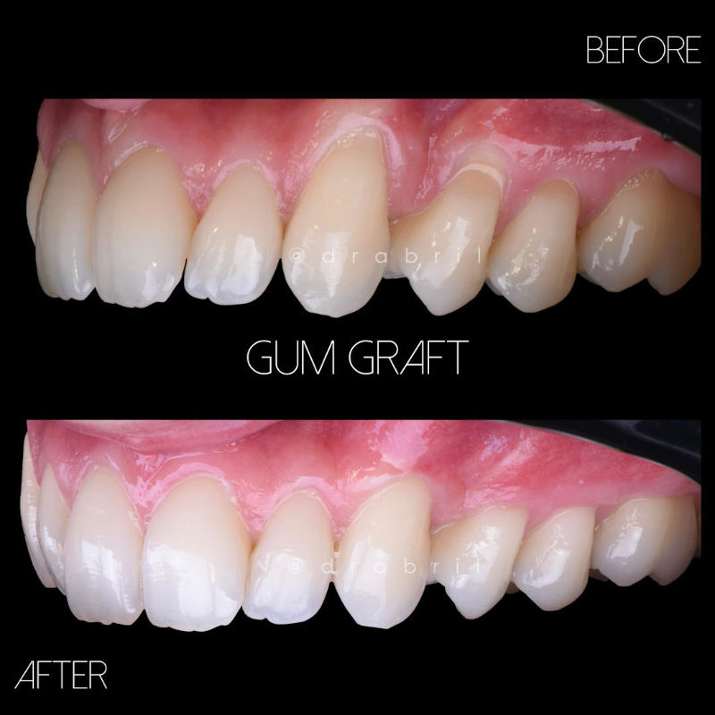 Before and after comparison of a gum graft procedure, showing improved gum tissue coverage on teeth.