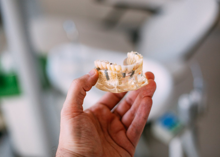 Hand holding a model jaw with dental implants in a dental office.