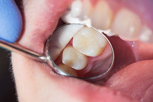 woman about to insert invisalign tray