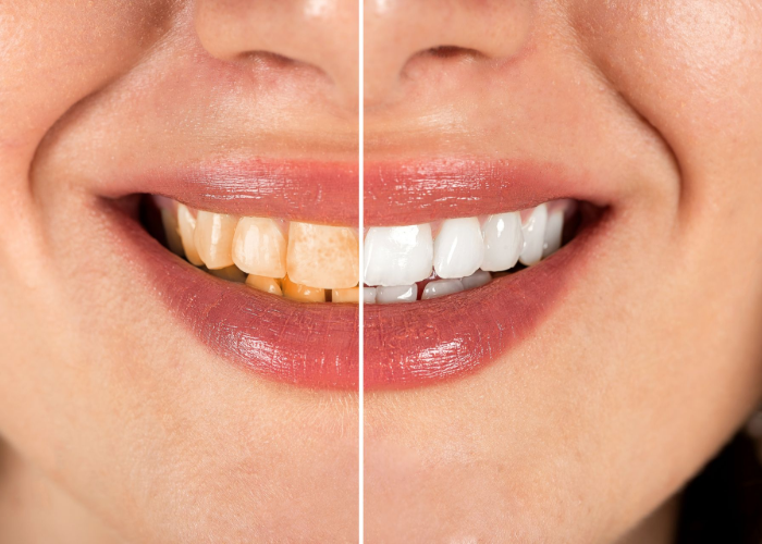A close up of a model of a tooth with a hole in it.