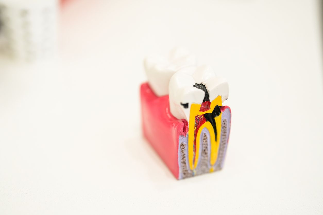 Model of a tooth with a cavity, showing the inner structures and decay in black.