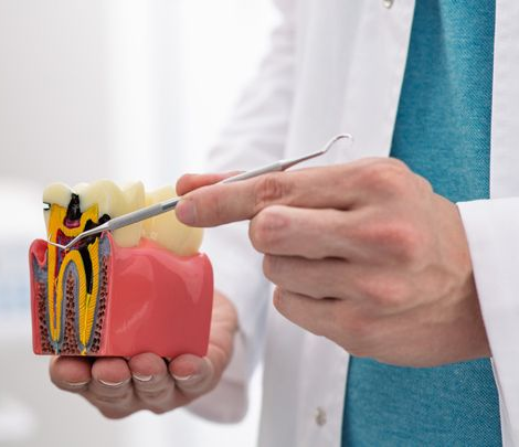 Dentist pointing to a cross-section model of a tooth, highlighting a cavity and root canal.