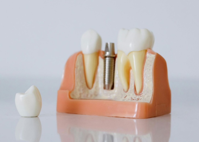 Dental implant model with a loose crown, displayed on a reflective white surface.